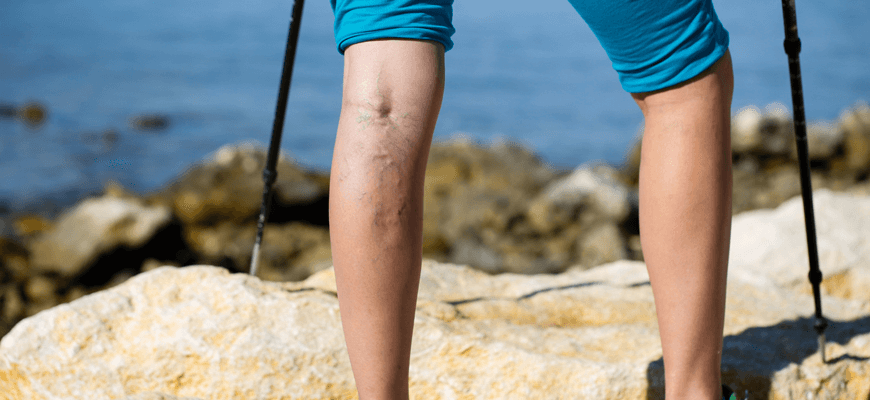 a hiker with varicose and spider veins - Palisades Vein Center