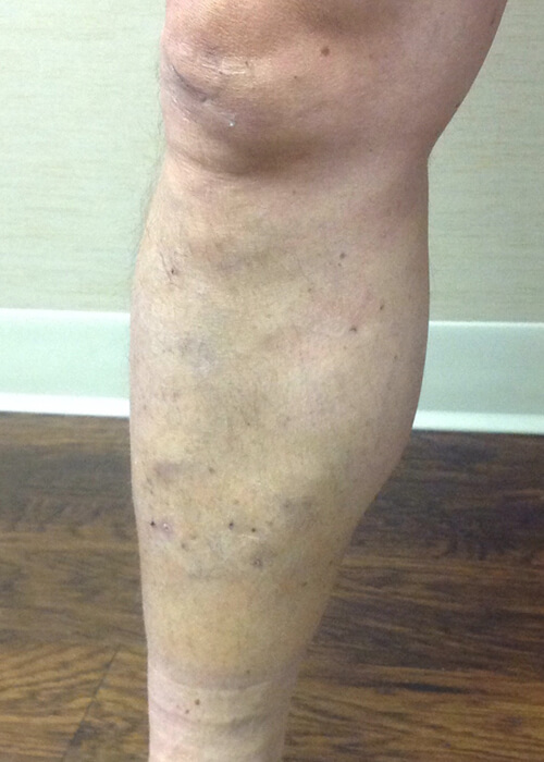 a leg after being treated for varicose veins - Palisades Vein Center