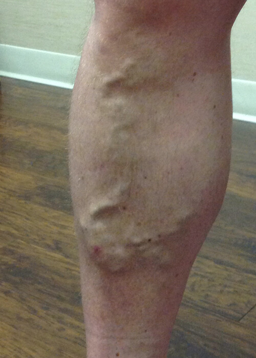 a man's leg with large varicose veins - Palisades Vein Center