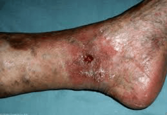 Palisades Vein Center Chronic Venous Insufficiency Resulting in Ulcer