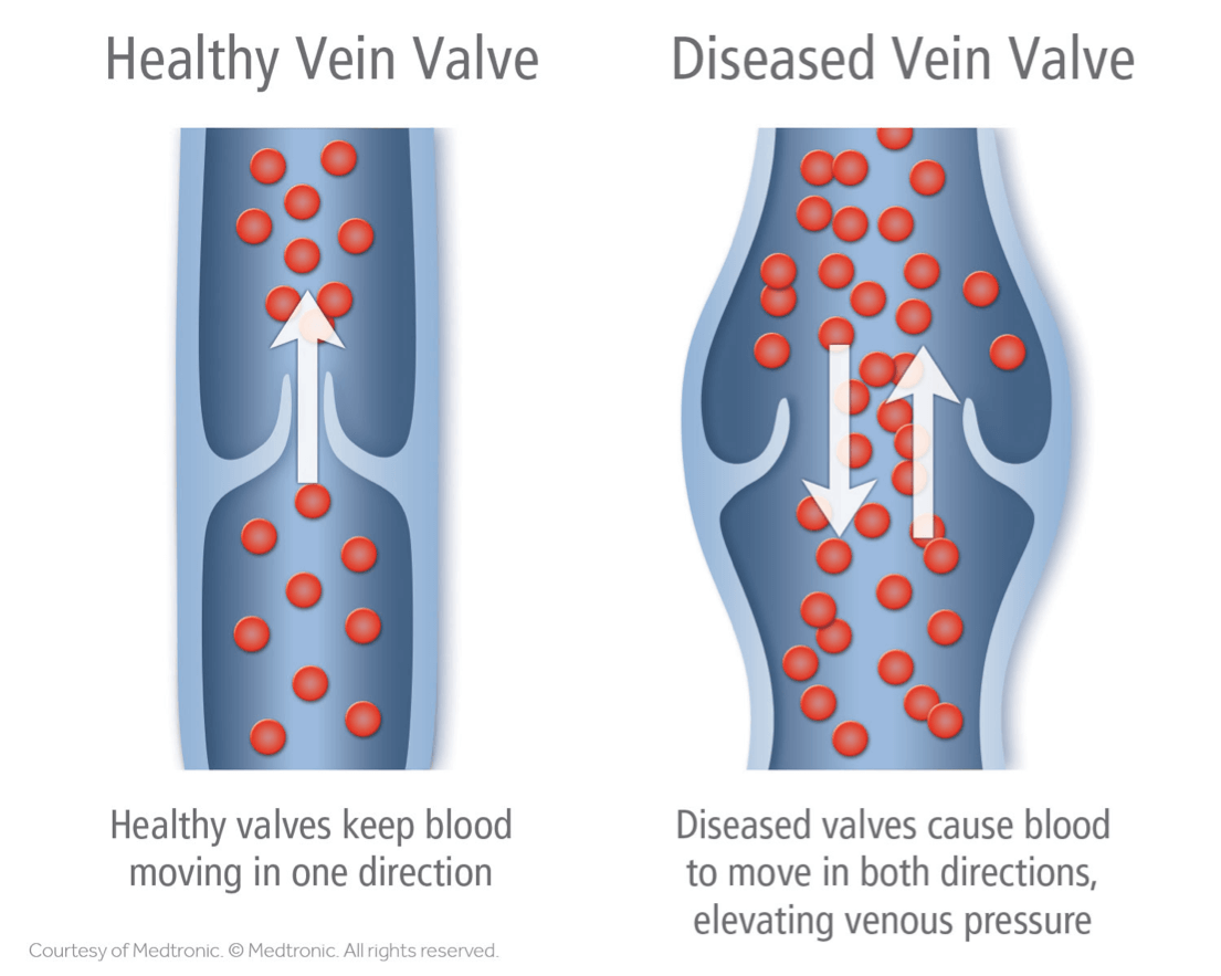 Palisades Vein Center Difference Between Healthy and Unhealthy Vein Valve