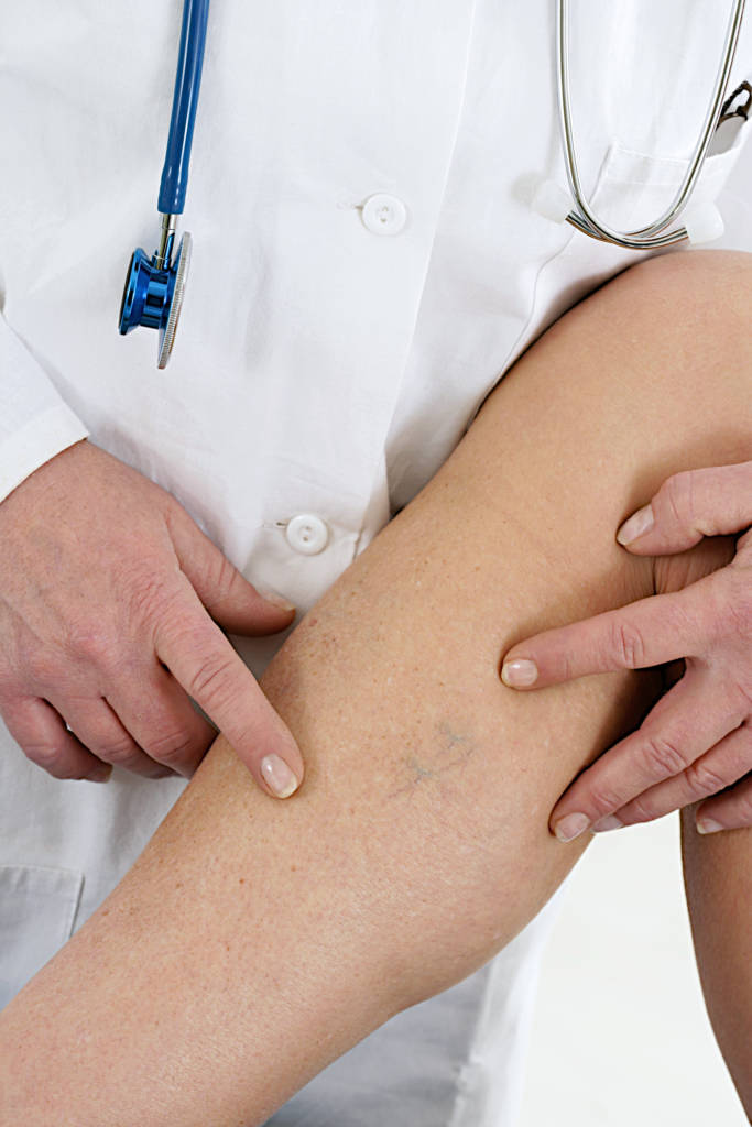 Palisades Vein Center- A doctor pointing out the varicose veins on a leg