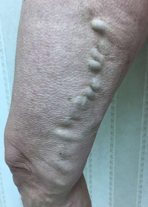 Palisades Vein Center- leg before varicose vein treatment