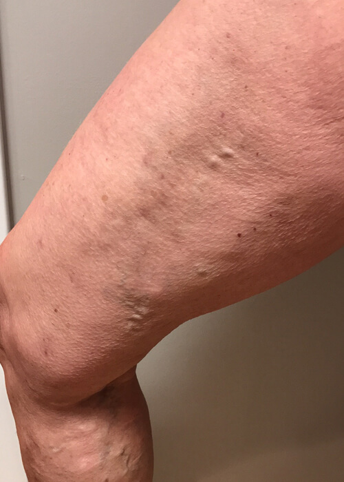 Palisades Vein Center- leg after varicose vein treatment