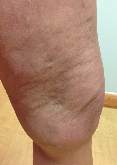 Palisades Vein Center- leg after treatment for visible veins