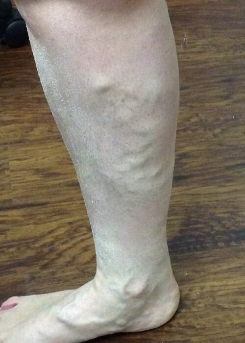 Palisades Vein Center- leg before vein treatment