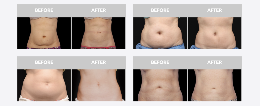 Palisades Vein Center - before and after