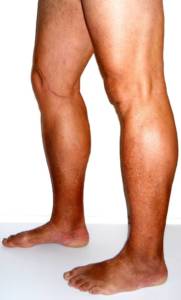Palisades Vein Center- tanned legs with visible varicose veins