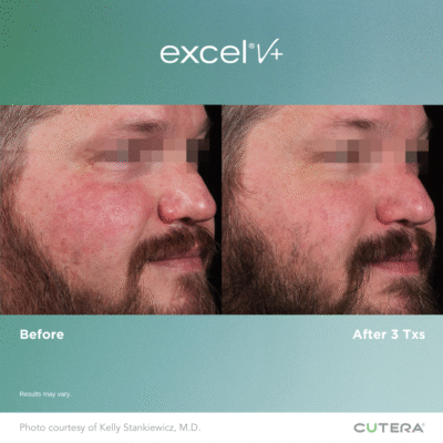 Excel V+ before and after result 1